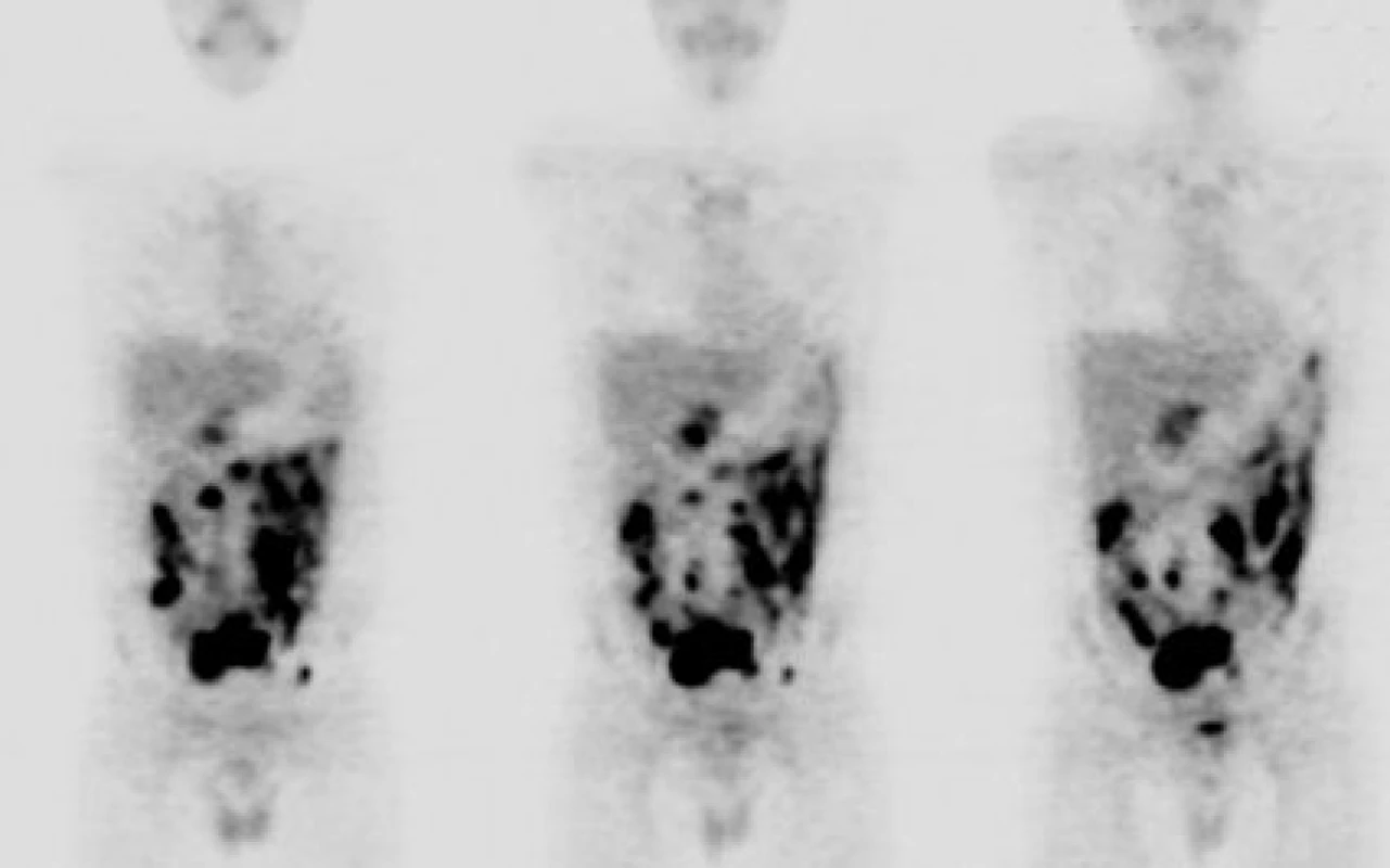 Diagnostika Burkittova lymfomu pomocí celotělové FDGPET (materiál Oddělení nukleární medicíny   a PET, MOÚ, Brno, zpracoval K. Bolčák).
Mnohočetná ložiska s enormně vysokým metabolismem glukózy (SUV 16-22) odpovídající vitální nádorové tkáni v dutině břišní, s maximem ventrálně (pravděpodobně na peritoneu) a ve středním hypogastriu, u pacienta s nově diagnostikovaným Burkittovým lymfomem.
