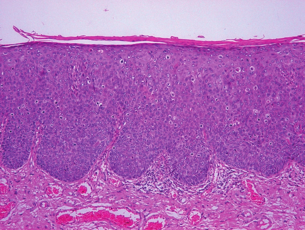 Histologický obraz vulvární HSIL (barvení hematoxylin-eozin, zvětšení 100)