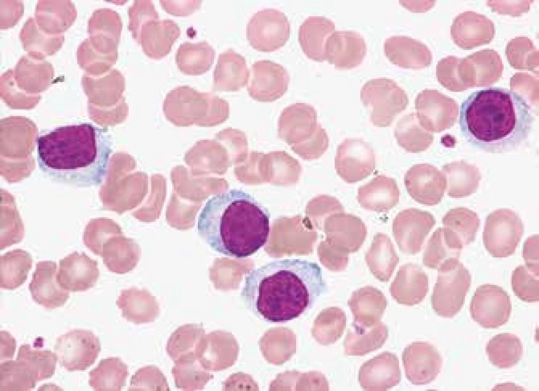 CD5+ MZL, lymfocyty s plazmocytoidní diferenciací (malé zralé lymfocyty s bohatou bazofilnější cytoplazmou a excentricky lokalizovaným jádrem s hutným jaderným chromatinem)