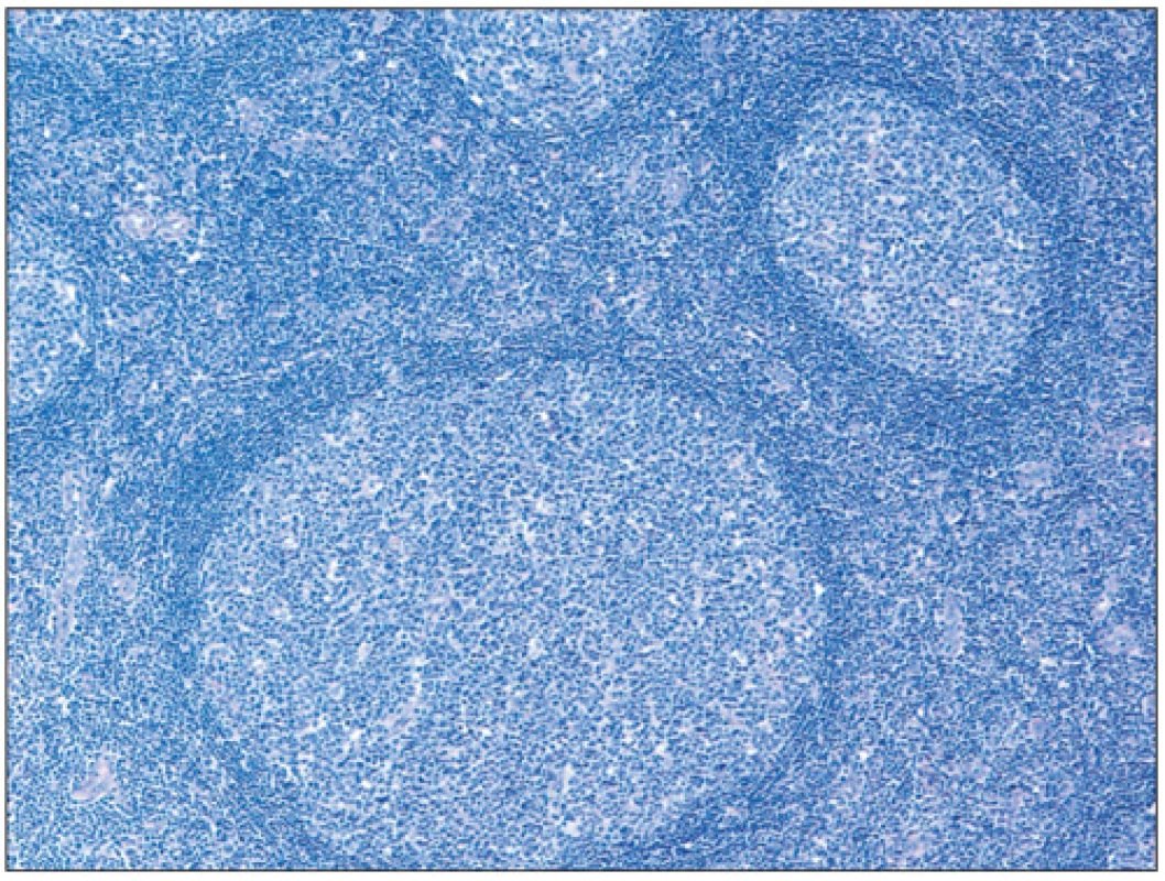 Obraz reaktivní lymfadenitidy/hyperplázie s polarizací folikulů (barvení hematoxylin-eosin; zvětšení 100x).