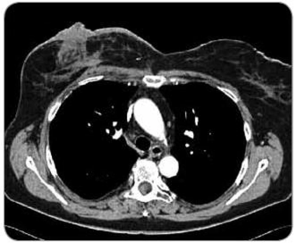 CT obraz hemangiosarkomu pravého prsu (pacient č. 1). Nepravidelný tumorózní útvar v pravém prsu o velikosti 4,5 x 5 cm.