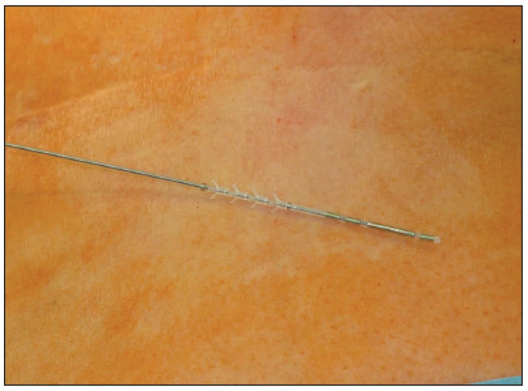 Permanentní elektroda s trny
Fig. 2. Permanent electrod tined lead