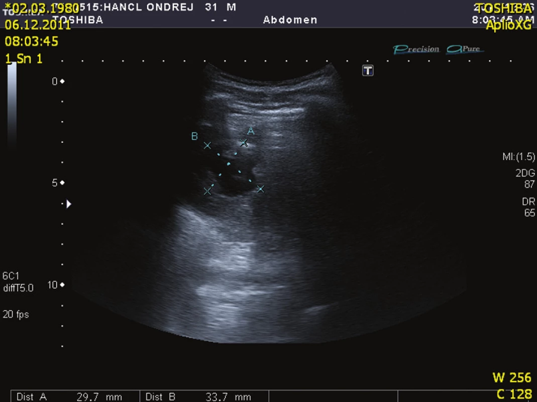USG kontrola po roce (kazuistika 2)
Fig. 10: Control ultrasound after one year (case 2)