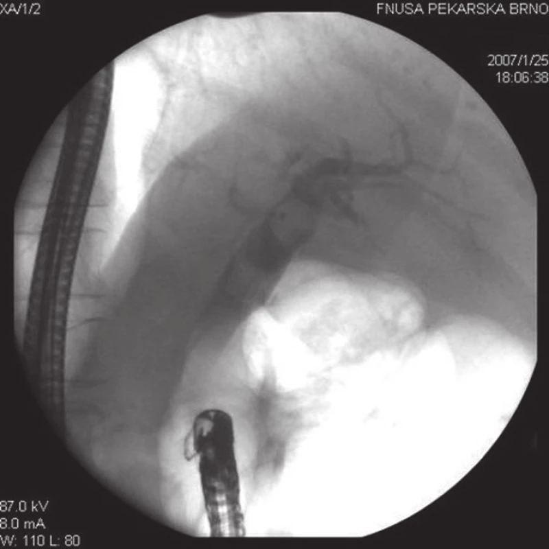 Při ERC u pacienta po resekci žaludku podle Billrotha II jsou v dilatovaných extrahepatálních žlučových cestách přítomny dva objemné konkrementy.