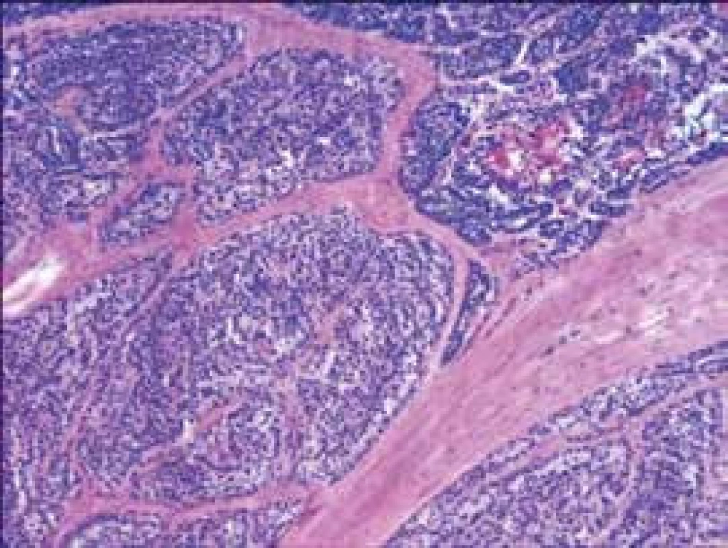 Histomorfologický obraz: alveolárna štruktúra s fibróznymi septami