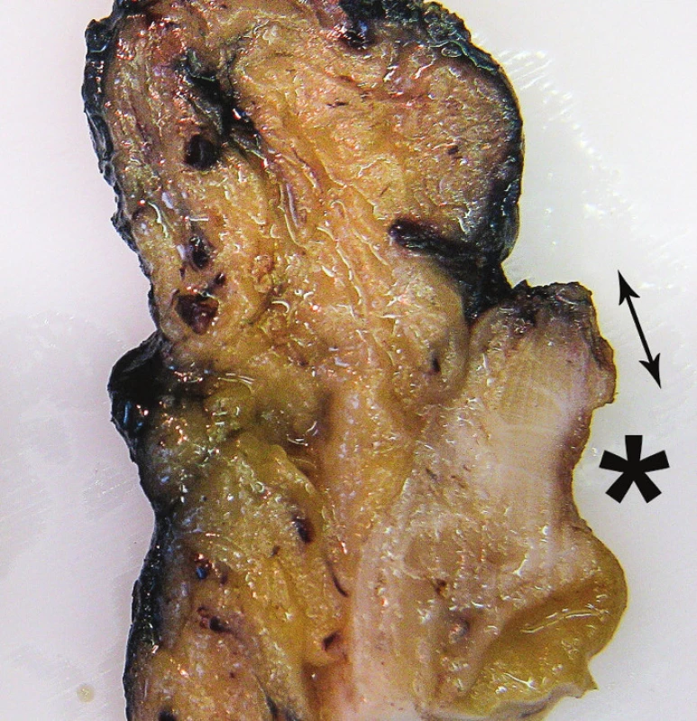 Nádor po NCHRT 
a) Drobná exulcerace sliznice (šipka) v těsné blízkosti DRO, b) detail zhotovené podélné lamely od exulcerace (*) směrem k DRO, k následnému mikroskopickému zhodnocení vzdálenosti reziduí nádoru od DRO (dvojitá šipka).
Fig. 3: Tumour after NCHRT
 a) Small mucosal ulcer (arrow) near the distal resection margin (DRM), b) detail of longitudinal section taken from ulcer (asterisk) to DRM for microscopic evaluation of the distance between the residual tumour and the DRM (double arrow).
