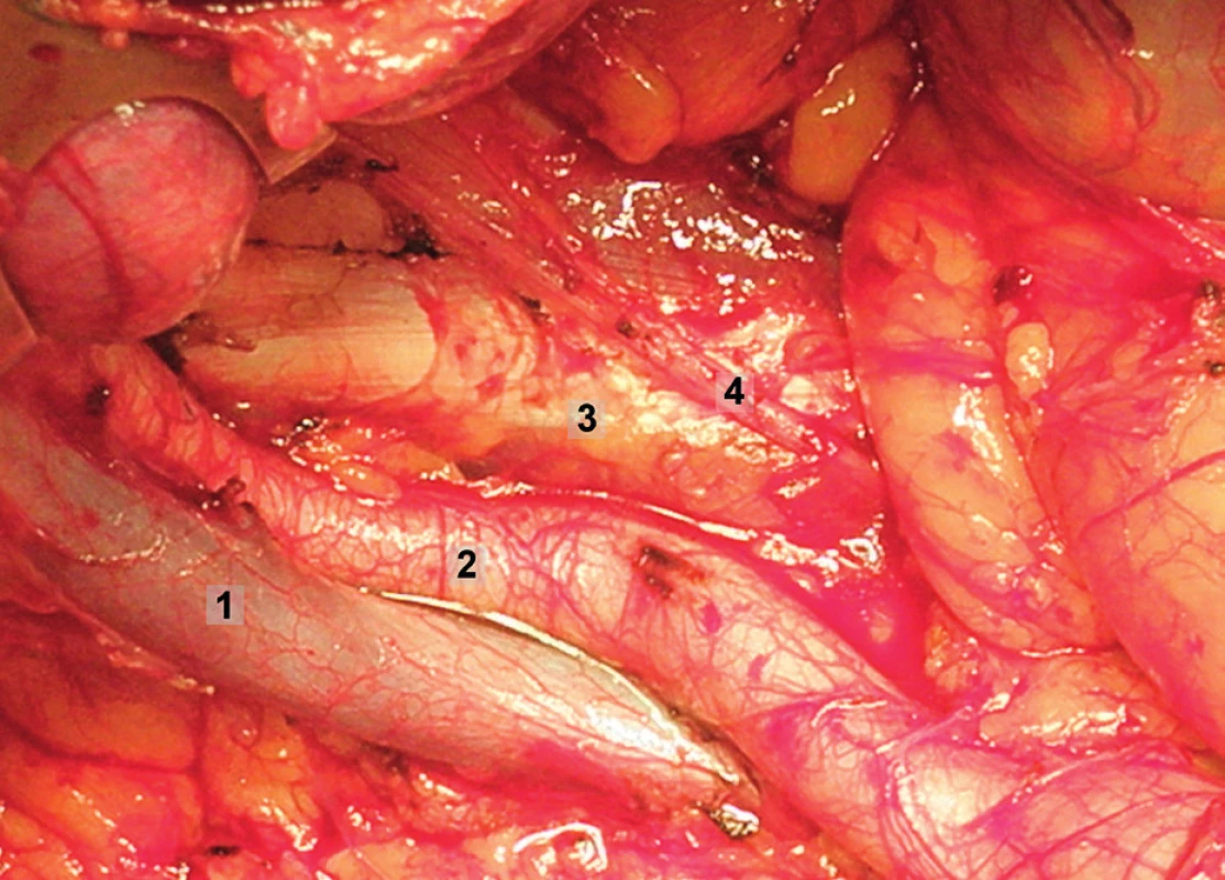 Systematická transperitoneální pánevní lymfadenektomie (pravá pánevní stěna) – druhý krok; tukově-lymfatická tkáň byla odstraněna z oblasti zevních a společných ilických cév, zachován průběh n. genitofemoralis a neporušena aponeuróza m. psoas. 1 – zevní ilická arterie, 2 – zevní ilická véna, 3 – musculus psoas, 4 – větve n. genitofemoralis