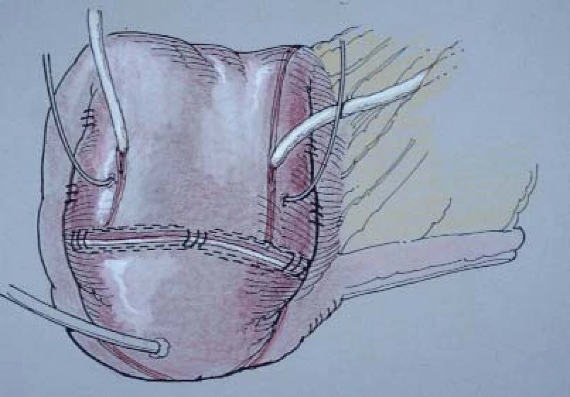 Tento nákres zobrazuje hotový „Indiana pouch“. Povšimněte si, že cékostomický katétr a ureterální stenty jsou zavedeny způsobem, který je popsán v této práci. Uretery nemusí být nutně implantovány v místě tenie.