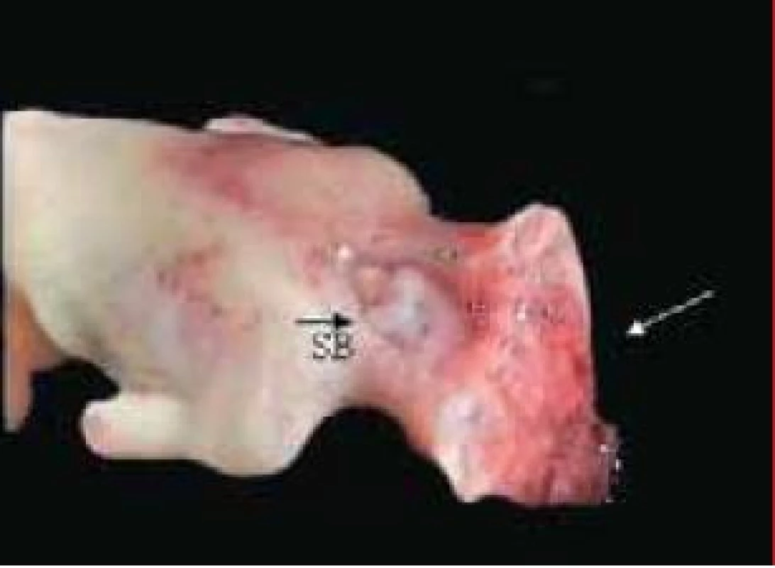 Anencefalus u plodu s karyotypom 46,XY (koniec 10. vývojového týždňa). Spina bifida v C – Th oblasti.