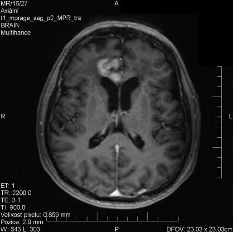 Vyšetření MRI s odstupem 19 dnů při kortikoterapii – výrazná regrese nálezu, pouze reziduální postkontrastní sycení v oblasti mediální části frontálního laloku vpravo.