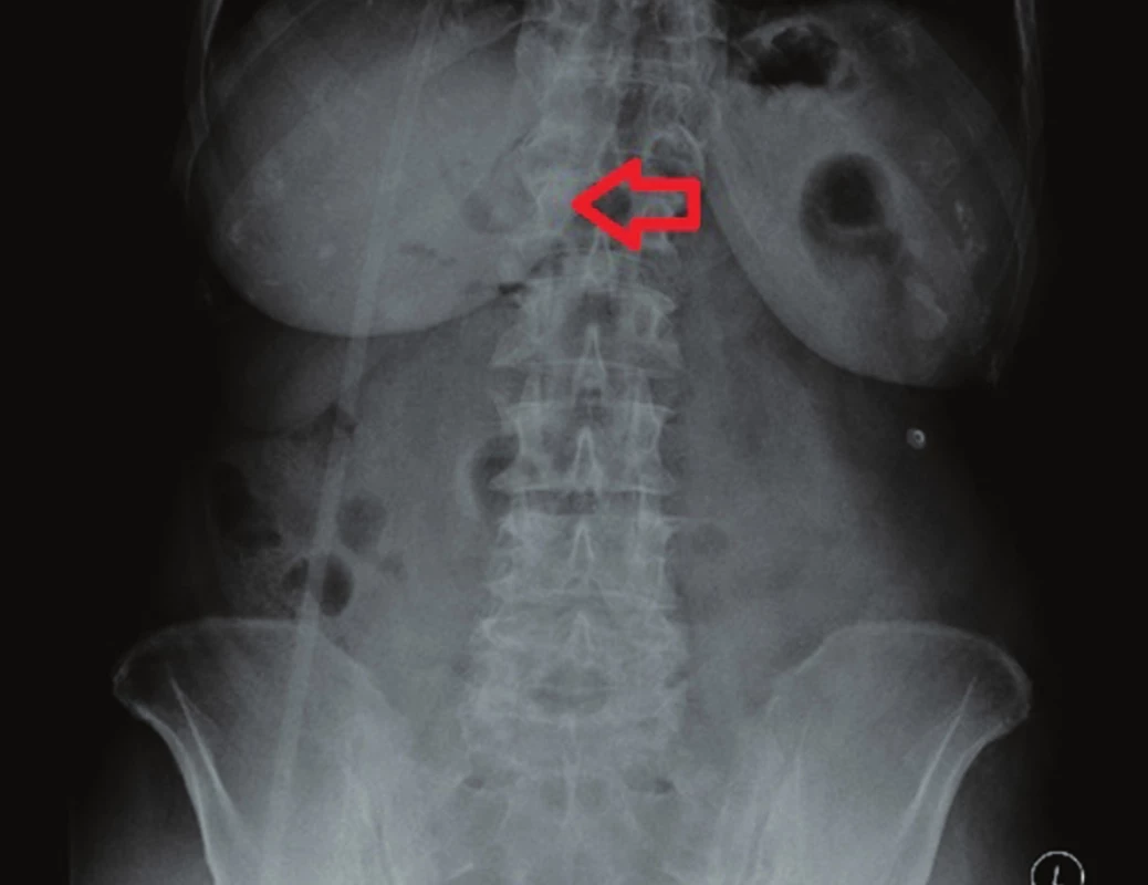 Předoperační RTG břicha – významná pneumobilie (šipka)
Fig. 3: Preoperative AXR – significant pneumobilia (arrow)
