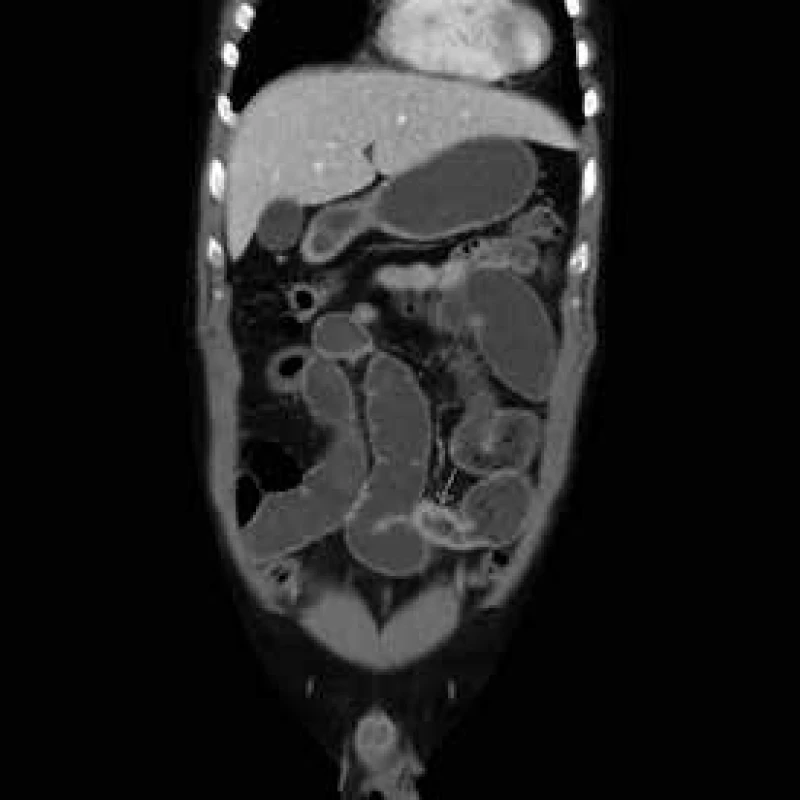 CT enterografie – vícečetné skip léze v rámci m. Crohn s prestenotickými dilatacemi