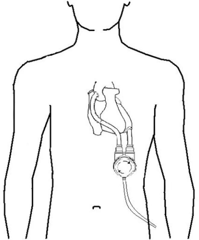 Pulzatilní typ levokomorové podpory
Fig. 1: Pulsatile left ventricular support
