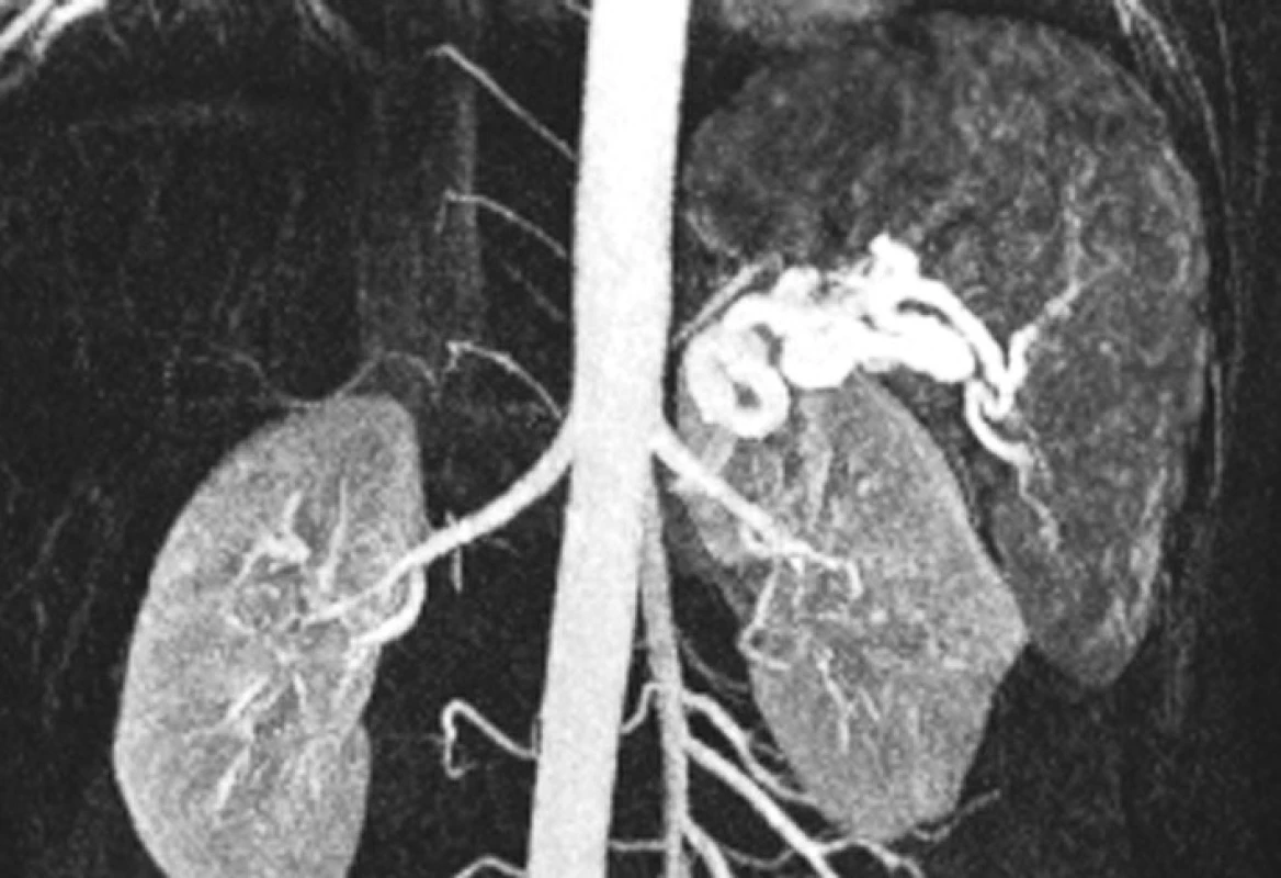 Nález aneuryzmatu lienální tepny (magnetická rezonance)
Fig. 2. A finding of the lienal artery aneurysm (MRI)