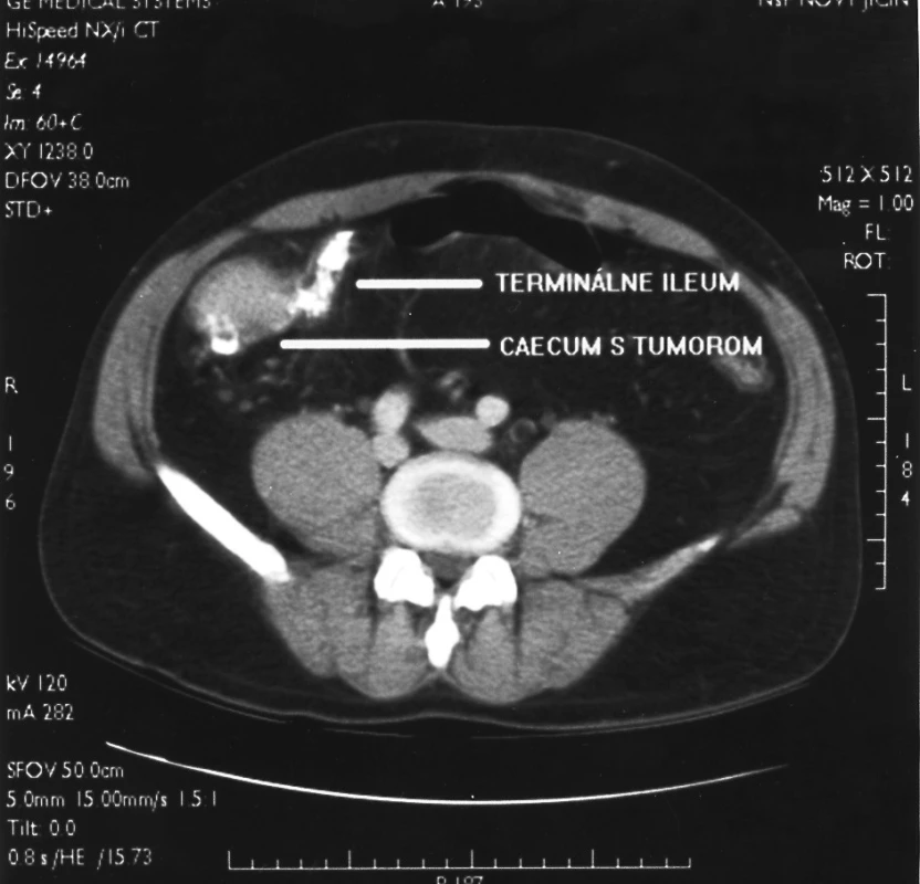 CT nález tumoru céka
Pic. 1. A CT finding of the caecal tumor