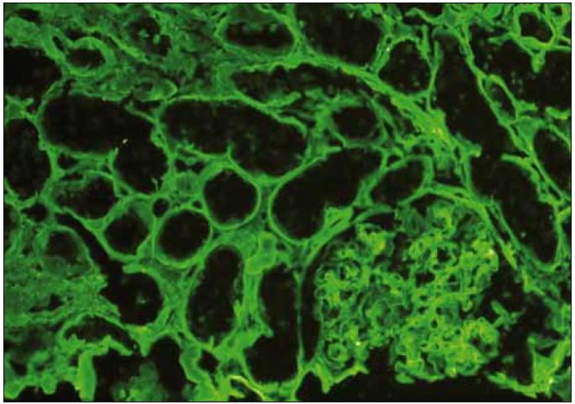 Imunofluorescence s pozitivním průkazem kappa v tubulárních bazálních membránách při LCDD. Onemocnění je pokročilé, pozitivní průkaz (zelená barva) je lineární. Imunofluorescence, lehký řetězec κ, zvětšení 20krát.