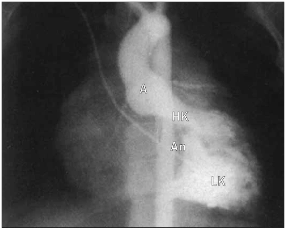 Angiogram levé komory v předozadní projekci u defektu typu ostium primum ukazuje deformitu „husího krku“.