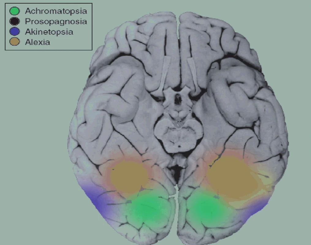 Poloha „těžiště“ neuronální sítě velkého rozsahu (konektomu) rozlišující lidského tváře je vyznačena červeně.
Celá síť je podstatně rozsáhlejší, rozlišuje různé aspekty lidských tváří a jejich proměn včetně emočních výrazů a důvěryhodnosti. Jejími součástmi jsou další zrakové korové oblasti a některé oblasti limbické a paralimbické kůry včetně amygdaly a očnicové kůry (přehled 18). Důsledkem poškození zeleně vyznačené oblasti je cerebrální achromatopsie, poškození modré oblasti je příčinou akinetopsie, poškození žluté oblasti způsobí alexii (32).