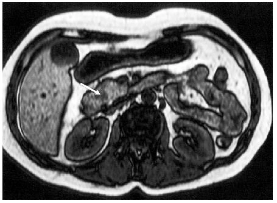 MR obraz nádoru v hlavě pankreatu (↑); nativně je v T1 váženém obrazu ložisko hyposignální