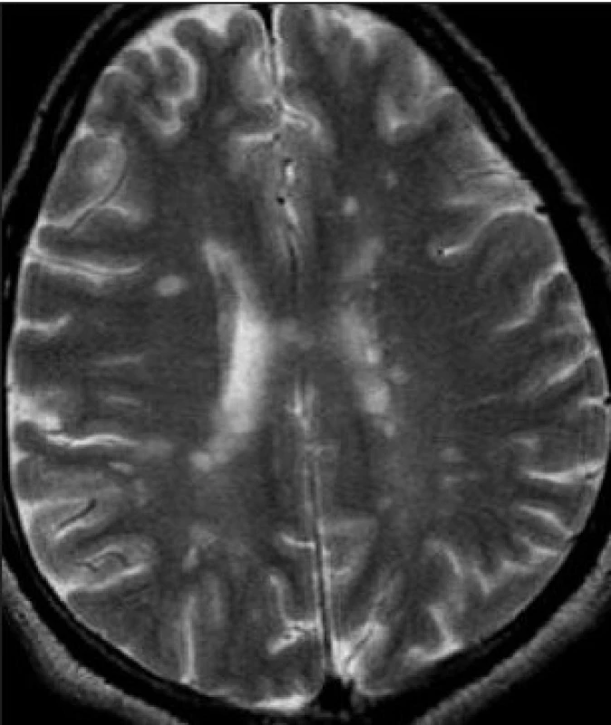 Leukoaraiózu v obrazu MR prozradí „projasnění“ periventrikulární bílé hmoty. Leukoaraióza je popisný neuroradiologický pojem označující poškození bílé hmoty z jakýchkoli důvodů, doprovází tedy jak VD, tak Alzheimerovu nemoc. Kognitivním poruchám odpovídá leukoaraióza jen do jisté
míry, obvykle při těžším postižení.