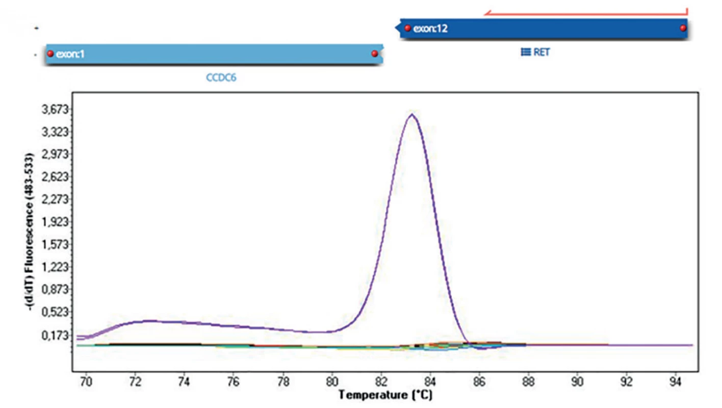 Detekce fúzního genu RET/PTC1 (CCDC6/RET)
Nahoře na obrázku detekce pomocí masivně paralelního sekvenování (fúze 1. exonu CCDC6 genu s 12. exonem RET
genu). Dole na obrázku detekce pomocí analýzy křivky tání metodou Real-Time PCR (fialově pacient s fúzním genem,
ostatní pacienti negativní).<br>
Fig. 2: Detection of RET / PTC1 fusion gene (CCDC6/RET)
In the figure above, detection by massively parallel sequencing (fusion of the 1st exon of the CCDC6 gene with the 12th
exon of the RET gene). In the picture below, detection by melting curve analysis by Real-Time PCR (purple patient with
fusion gene, other patients negative).