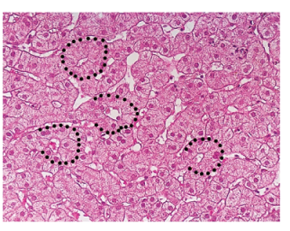 Morfologie chronické cholestázy s jaterní tkání přestavěnou do tzv. cholestatických rozet (část z nich lemována černě). H&amp;E, zvětšení objektiv 40x.