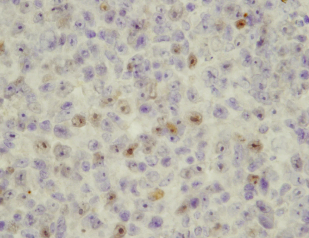 Imunohistochemický průkaz exprese p53 v buňkách maligního melanomu uvey, prokázána mírná akumulace p53 v jádrech některých buněk (původní zvětšení 800krát)
