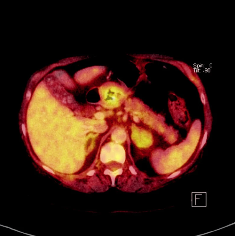 PET-CT: tumor žaludku
Fig. 1. PET-CT: gastric tumor