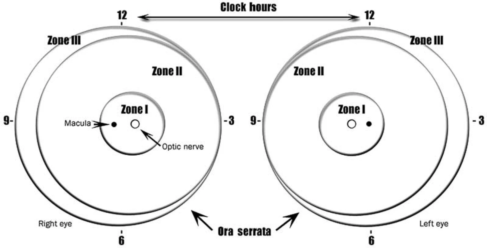 Schéma sietnice pravého a ľavého oka, znázorňujúca ohraničenie zón a číslic číselníka hodín, používané pre popis lokalizácie a rozsahu zmien pri ROP. Zóna II sa ešte rozdeľuje na centrálnu – posteriórnu časť, ktorá nalieha na zónu I a periférnu čast Zóna III sa nachádza len v temporálnej časti sietnice.