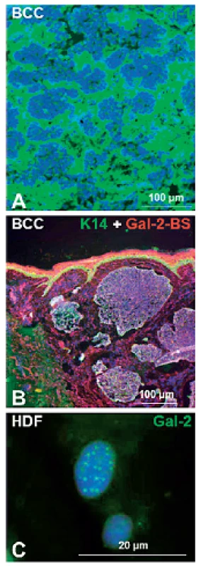 Galektín-1 je výrazne exprimovaný v stróme bazaliómov (BCC) (A). Značený galektín-2 rozpoznáva väzbové miesta normálnych aj nádorových epitelových buniek (Gal-2-BS) (B). PML (promyelocytický leukemický proteín) telieska v jadrách stresovaných ľudských dermálnych fibroblastov (HDF) exprimujú galektín-2 (C). DNA je v každom obrázku ofarbená modro pomocou DAPI