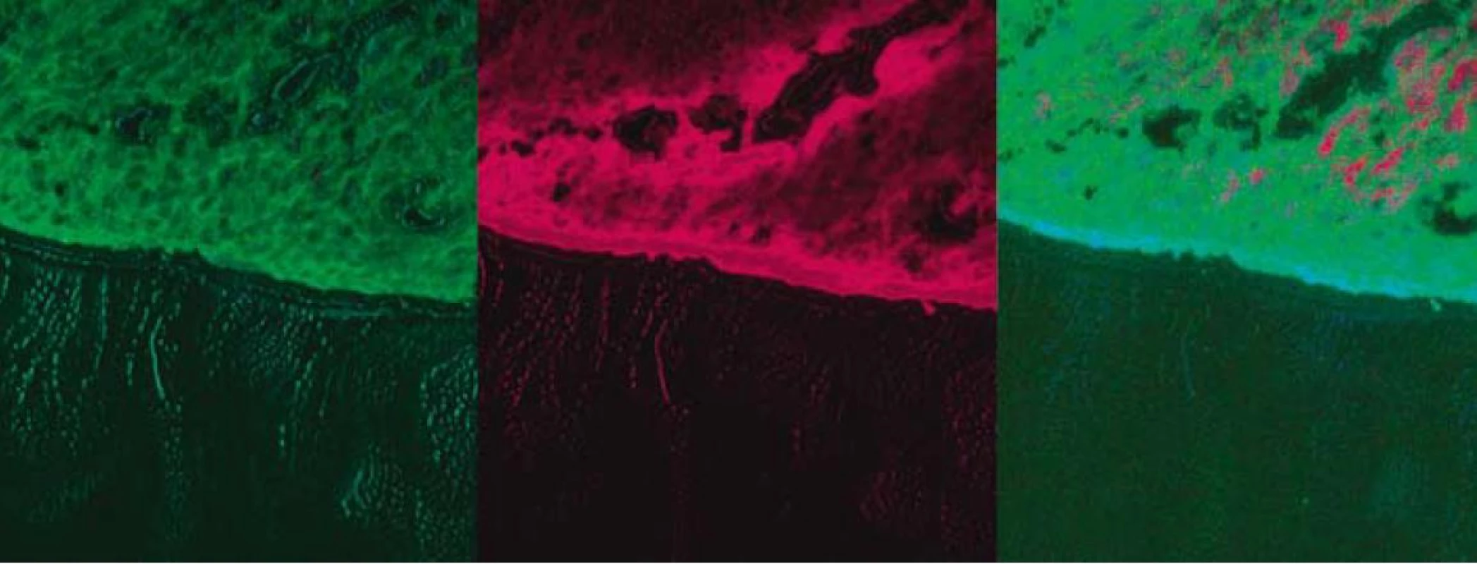 Fluorescenčná štúdia s použitím fotosenzitizátora ALA – tubulárny adenóm rekta s LGD.
Fig. 2. Fluorescence study with photosensitizer ALA – tubular rectal adenoma with LGD.