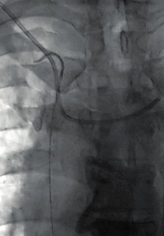 Endovaskulární repozice konce dislokované cévky zpět do horní duté žíly pomoc katétru typu „pigtail“ zavedeného cestou pravé femorální žíly
