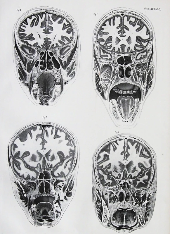 Anatome topographica, série řezů hlavou a mozkem