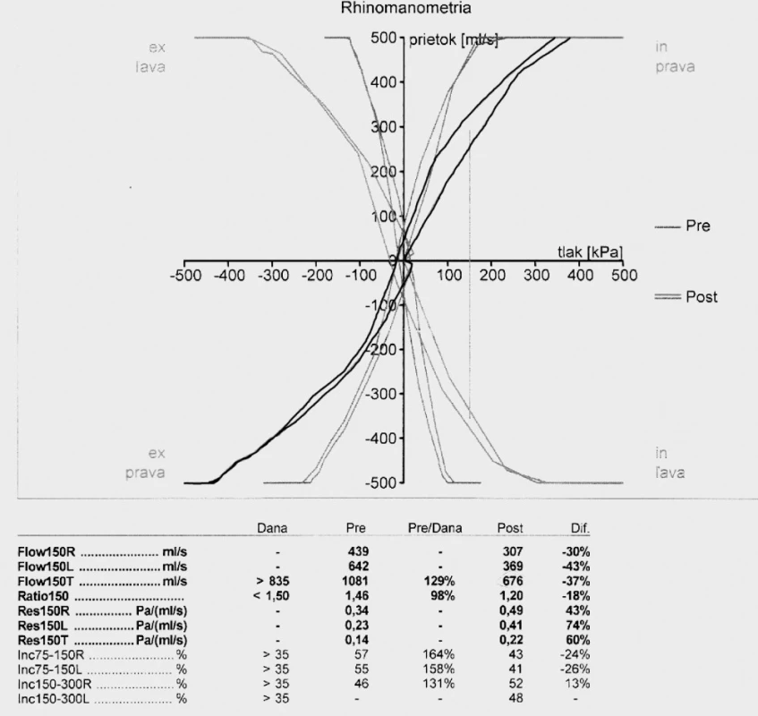 Pozitívny expozičný test (černé krivky – rinogram pred pracovnou zmenou, šedé krivky – rinogram po pracovnej zmene)
