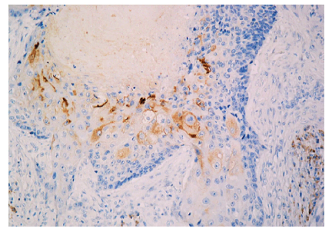 Imunohistochemické farbenie bazoskvamóznej aasti karcinómu na epitelový membranový antigén (EMA). Skvamoidne partie sú fokálne slabo pozitívne (EMA DAKO, zvačšenie 240x).