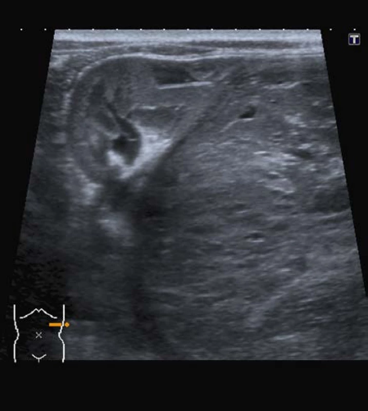 Ultrazvuk; nefroblastom dolního pólu ledviny vlevo
Fig. 2. Ultrasound; nephroblastoma of left kidney (Wilms‘ tumor)
