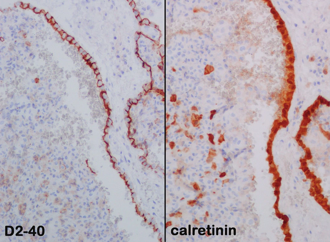 Imunohistochemické vyšetření markerem D2-40 a calretininem: přítomnost exprese obou markerů ve výstelce cyst, negativita v solidní části afekce