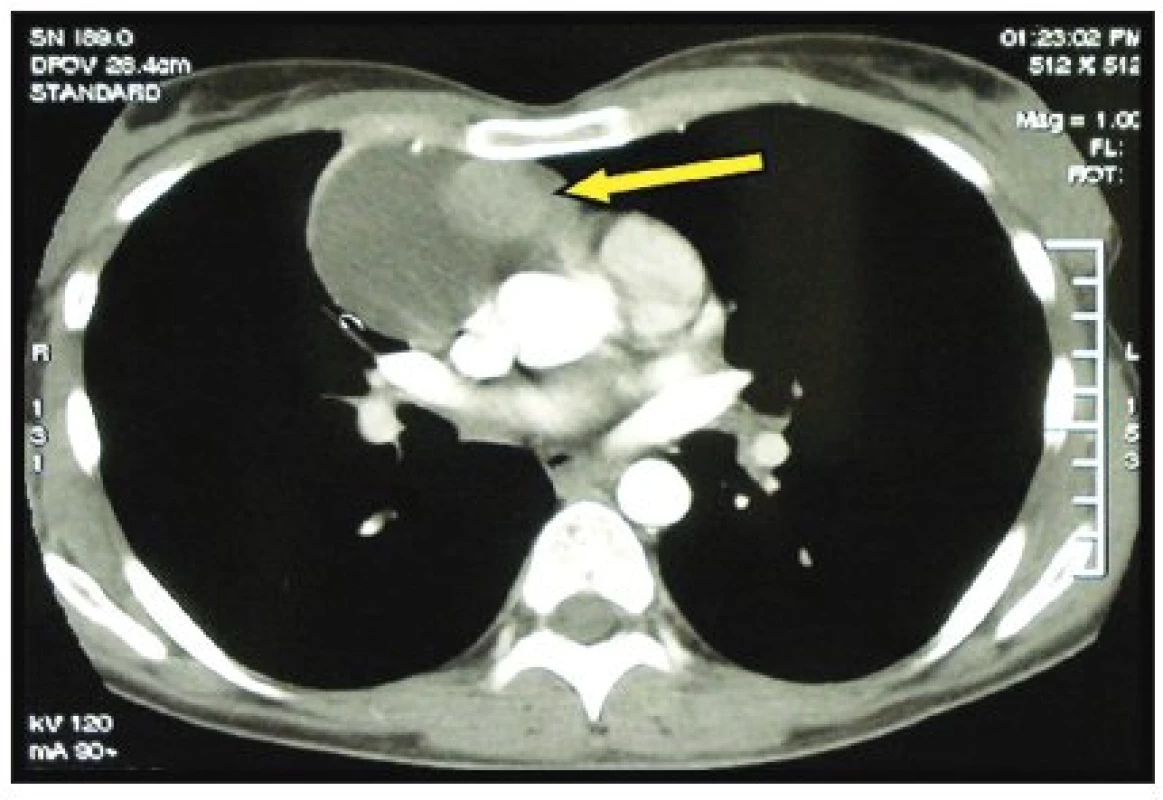 CT obraz tymické cysty s tymomem (šipka)
Fig. 1. CT scan of thymic cyst with thymoma (arrow)