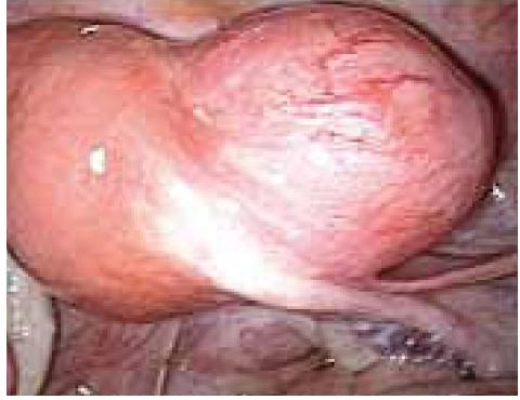 Děložní myom