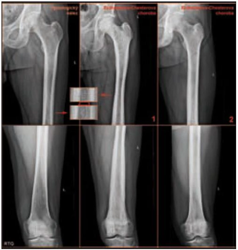 Srovnání normálního nálezu na skiagramu stehenních kostí a nálezu při postižení skeletu Erdheimovou-Chesterovou chorobou.

(1) Symetrické difuzní postižení osteosklerotickým procesem s ušetřením středních diafýz a distálních epifýz femorů. Kortikalis je v proximální a distální diafýze z vnější strany ztluštělá. V detailu je znázorněno zúžení dřeňové dutiny stehenní kosti u nemocného v porovnání s normálním nálezem. Na rozdíl od řady kortikálních apozic (renální osteodystrofie, potraumatické stavy a další), které po přestavbě dřeňovou dutinu zachovávají nebo je zúžení přítomno jen v krátkém úseku, dochází u pacientů s Erdheimovou-Chesterovou chorobou k pozvolnému zužování dřeňové dutiny, aniž by byly kromě zesilování kortikalis patrné jednoznačné změny struktury skeletu.

(2) Oboustranně difuzní zvýšení opacity stehenních kostí zesílením kompakty, která zužuje projasnění nitrodřeňové dutiny.