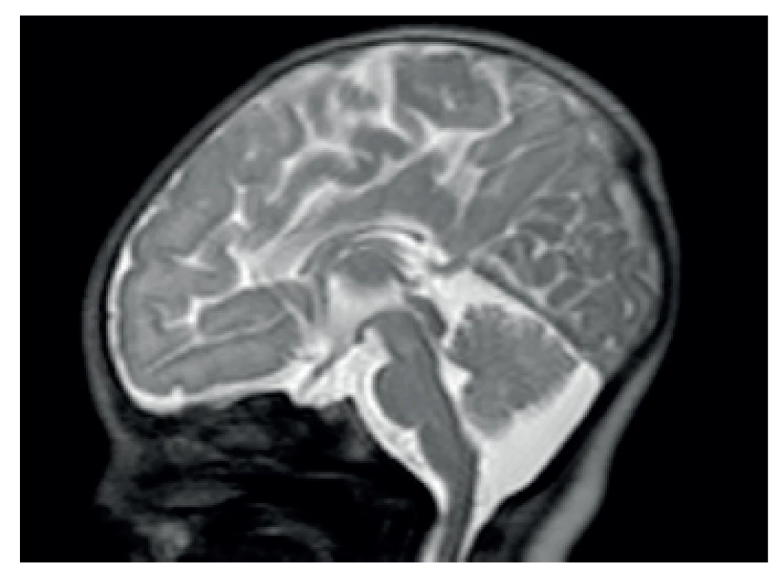 MR dysgeneze kalózního tělesa.
Fig. 2. Magnetic resonance imaging – corpus callosum dysgenesis.