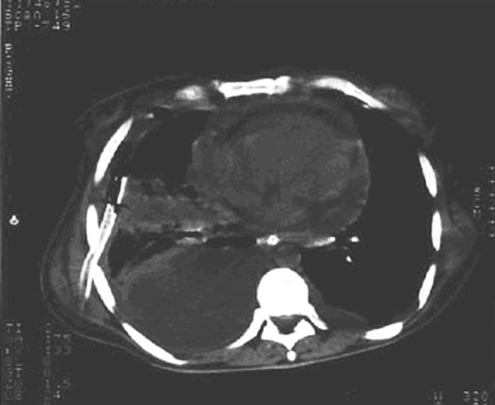 CT snímek hrudníku s drénovaným výpotkem a empyémovou dutinou cíleně
Fig. 2. A CT scan of a thorax with drained exudate and empyema cavity