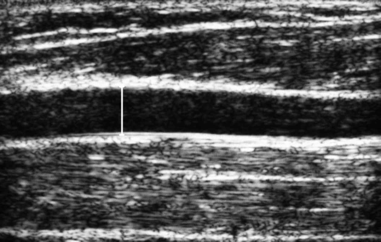 Meranie priemeru brachiálnej artérie pomocou lineárnej sondy v B-mode. Bazálny a posthyperemický priemer brachiálnej artérie stanovený meraním end-diastolickej vzdialenosti medzi protiľahlými luminálnymi plochami médie cievnej steny (šípka) po predchádzajúcej identifikácii lumenu artérie pomocou Dopplerovského princípu. Foto: RNDr. V. Cucak
Fig. 1. Measurement of the brachial artery diameter by means of the linea probe in B-mode. Basal and post-hyperemic diameter of brachial artery determined by measuring end-diastolic distance between opposite luminal surfaces of vascular wall tunica media (arrow) after previous identification of lumen by means of the Doppler principle. Photo Dr. V. Cucak