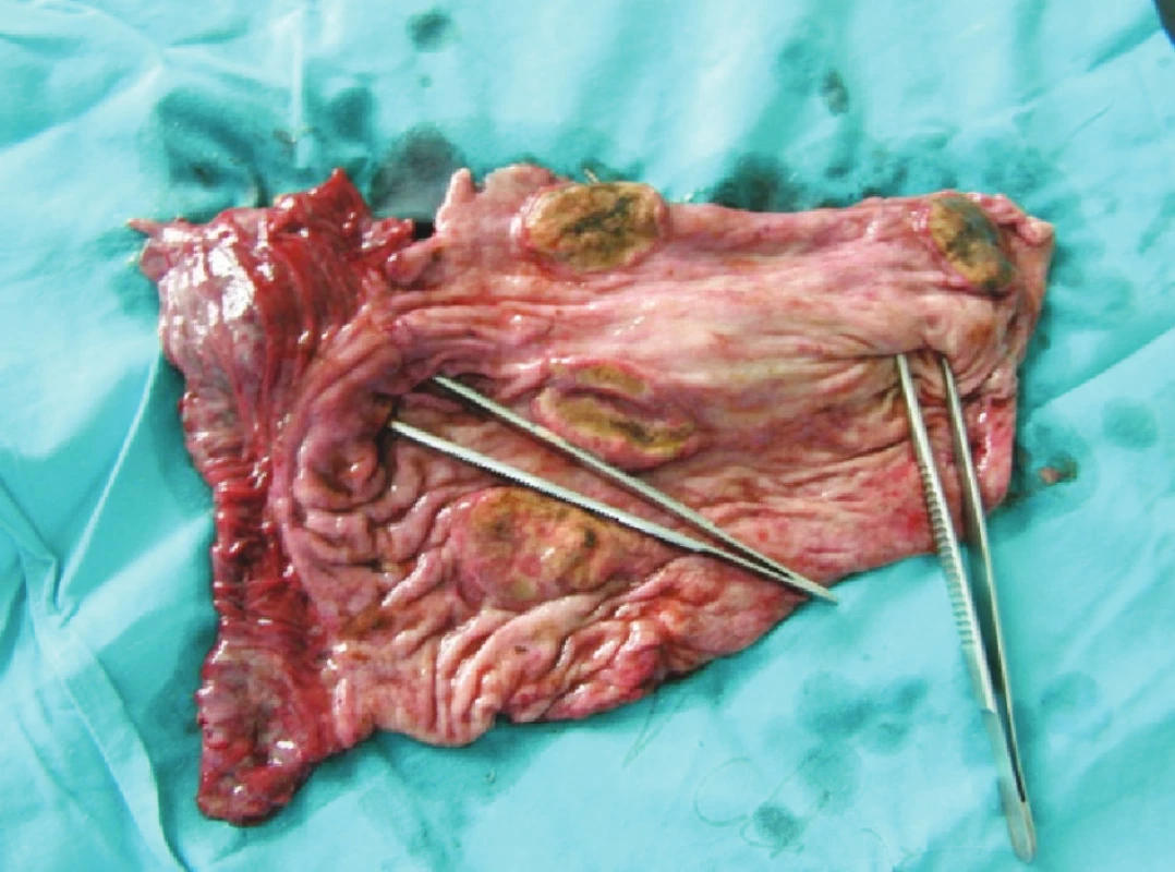 Exulcerácie žalúdka – zdroj krvácania (pinzety v kardii a pylore)
Fig. 3. Gastric exulcerations– sources of bleeding (pincers within the cardia and pylorus)
