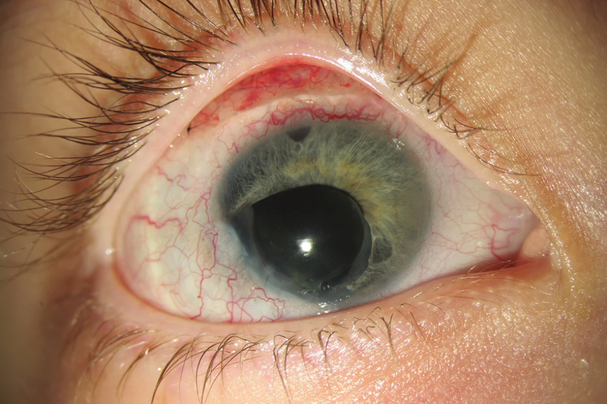Pravé oko po 2. operaci - trabekulektomii s mitomycinem C a bazální iridektomií
