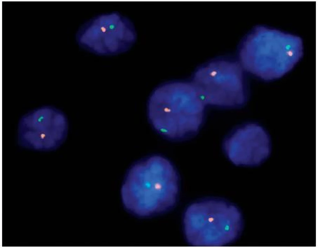 Fluorescenční in situ hybridizace (FISH) dokazující monosomii chromozomu 1 pomocí sond umístěných v lokusech 1p36 (oranžové signály) a 1q25 (zelené signály)
Fig. 2. Fluorescent in situ hybridization (FISH) proving loss of chromosome 1 using probes in loci 1p36 (orange signals) and 1q25 (green signals)