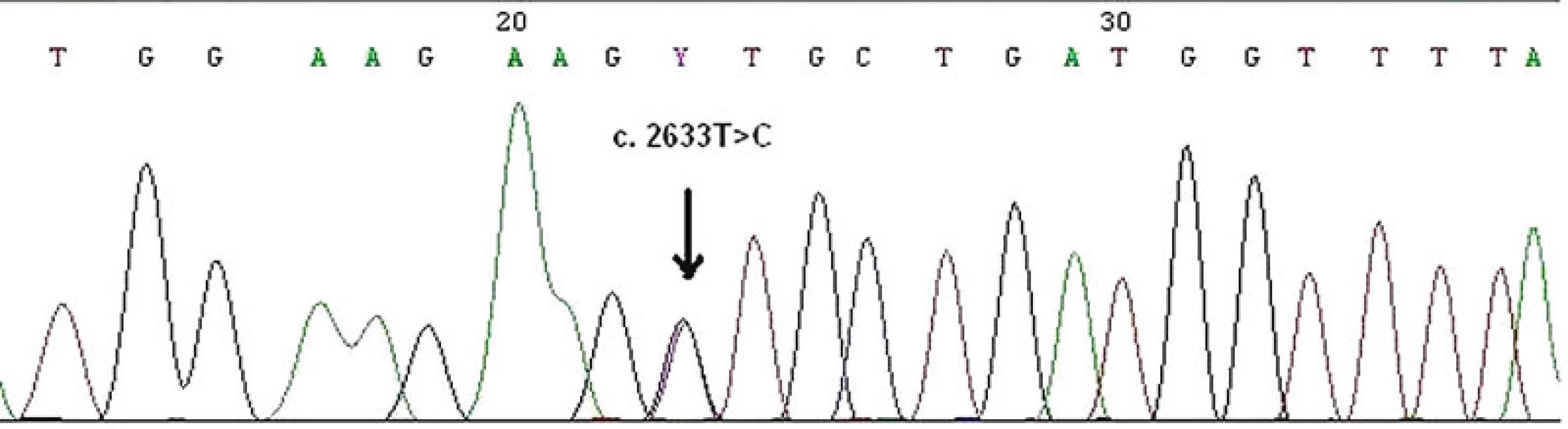 Zárodečná bodová mutace c.2633T&gt;C ve čtvrtém exonu MSH6 genu v periferních lymfocytech zjištěna metodou přímého sekvenování. Jde o tzv. missence mutace, kdy ve vznikajícím proteinu dochází k záměně aminokyseliny, a to valinu za alanin v kodonu 878.