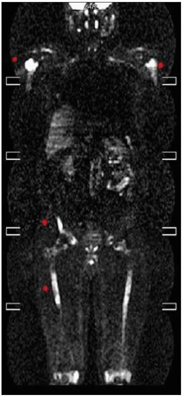 Celotělové MR vyšetření v T1 váženém obraze a koronární rovině. Patrný je abnormálně snížený signál z kostní dřeně s maximem v oblasti obou femorů a tibií (šipky) oboustranně. Nehomogenity jsou přítomné i v proximálních metafýzách obou humerů. Jedná se o obraz kumulace abnormálních histiocytů, které tak nahrazují normální tukovou kostní dřeň a působí snížení signálu v T1 obrazech.