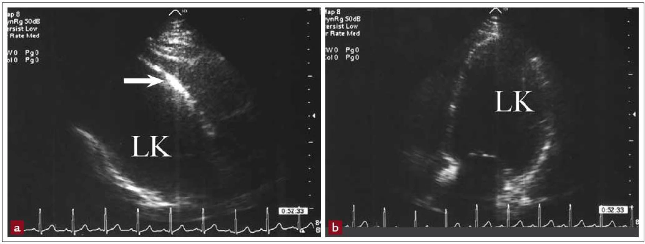 Dilatace levé komory po předním infarktu myokardu: a) ztenčelé a odrazivé septum, b) dilatovaná LK.