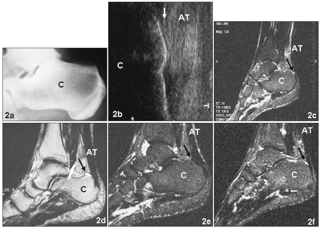 a. RTG snímek pravé patní kosti zdravého jedince (kazuistika a) v boční projekci
b. Ultrasonografie stejné paty téhož pacienta jako na obrázku 2a. Mírná plantární flexe. Šipka označuje oblast předpokládané zdravé RB
c. MR stejné oblasti téhož pacienta jako na obrázku 2b. Šipka označuje místo vyššího signálu v oblasti RB
d. MR paty pacienta s diagnózou retrokalkaneární burzitídy (kazuistika b). Šipka označuje prostor patologicky rozšířené burzy do tvaru frygické čapky
e. MR paty pacienta po chirurgickém odstranění RB (kazuistika c). Šipka označuje místo uložení původní burzy
f. MR paty pacienta 1 týden po distorzi hlezenního kloubu (kazuistika d). Vyšší signál v oblasti RB je označen šipkou
Fig. 2a. Lateral X-ray image of the right calcaneus of a healthy 36-year-old individual (cross country ski-marathon runner – case report a)
b. Ultrasonography of the heel region (in mild plantar flexion) of the same patient as in the Fig. 2a. The arrow designates the region of the healthy RB localization
c. MR image of the right foot of the same patient as in the Fig. 2a and 2b. The arrow designates a higher signal in the region of the RB
d. MR image of the 58-year-old patient suffering on the retrocalcaneal bursitis (case report b). The arrow designates the space of pathologically dilated RB in a shape of a Phrygi helmet
e. MR image of a 52-year-old patient (10 years after the surgical excision of RB for the diagnosis of chronical retrocalcaneal bursitis – case report c – cross country and marathon runner). The arrow designates the point of the originally placed RB
f. MR image of a 23-year-old patient (one week after the ankle joint distorsion – case report d – non sporting medical student). The arrow designates a higher signal in the region of normal RB